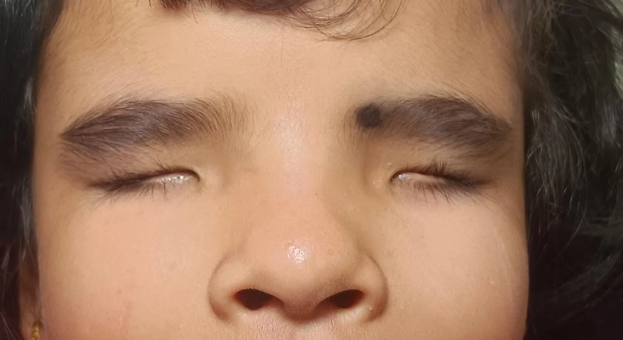 Congenital Microphthalmia or Anophthalmia