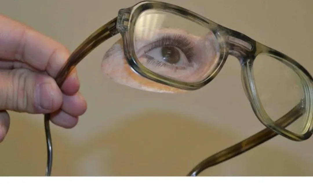 Spectacle Mounted Prosthesis